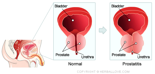 Benign Enlargement of Prostate and Prostate Cancer | Advanced Center of  Kidney & Urology